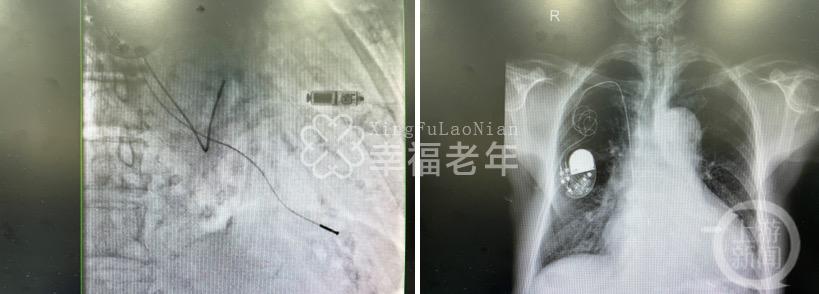 ▲仅2克重的起搏器已植入郭大爷的心腔内